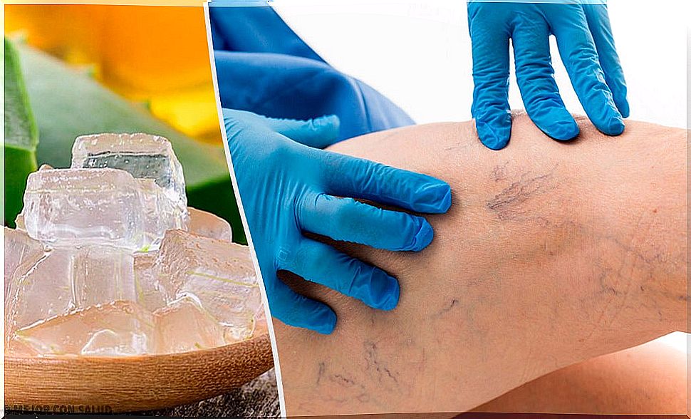 5 alternatives to treat varicose veins