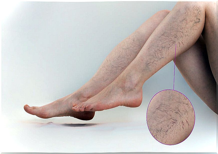 Exercises for varicose veins