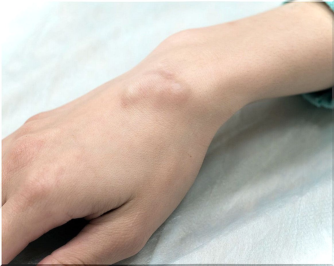 What are skin cysts? 