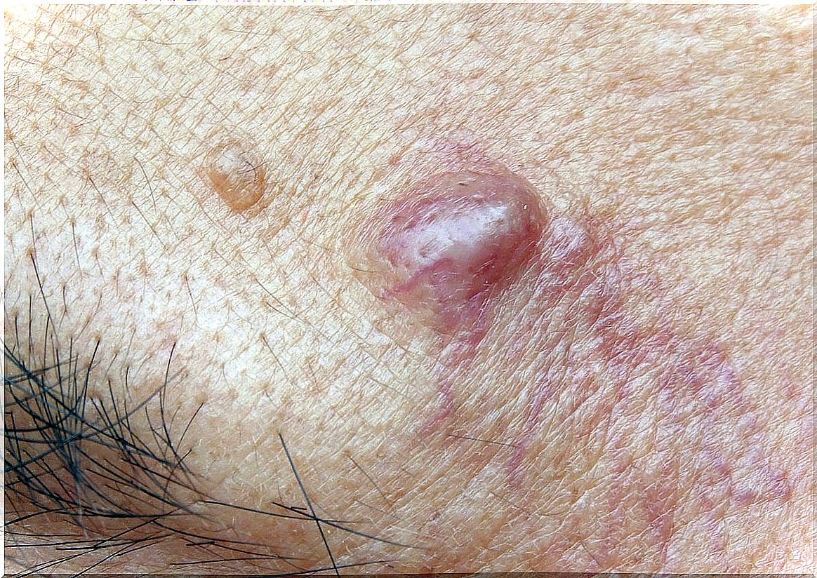 Epidermoid cysts