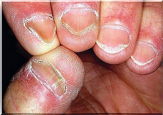 nails with Coilonychia