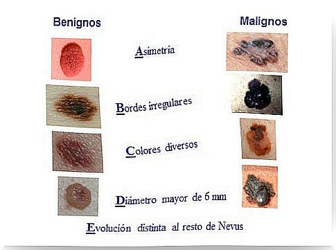 Melanomas