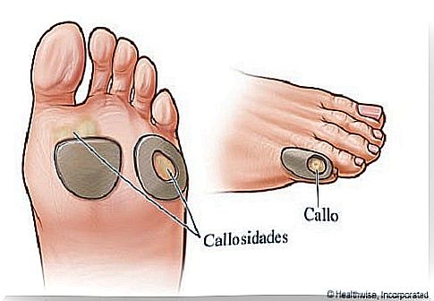 calluses