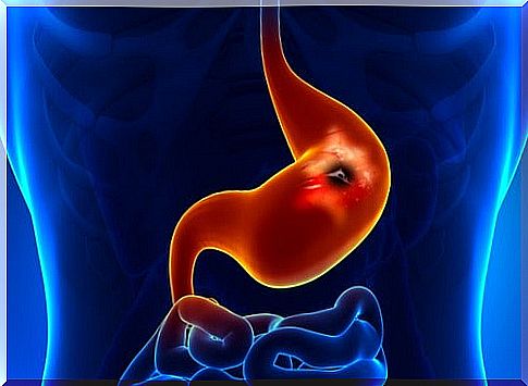 How to treat stomach ulcers naturally