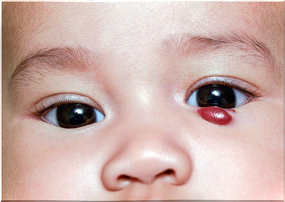 Infantile hemangiomas, what are they?