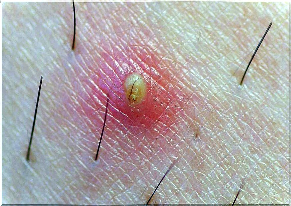 Ingrown hair prevention