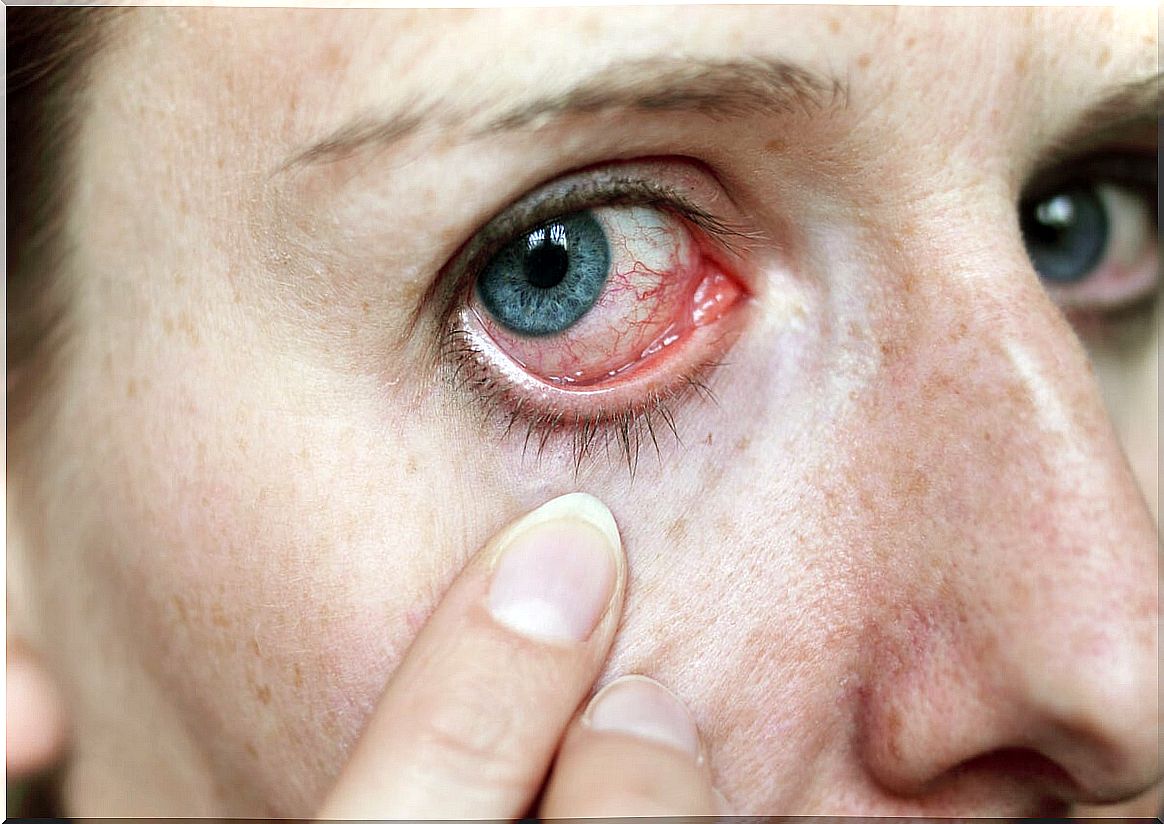 Conjunctivitis due to false eyelashes.