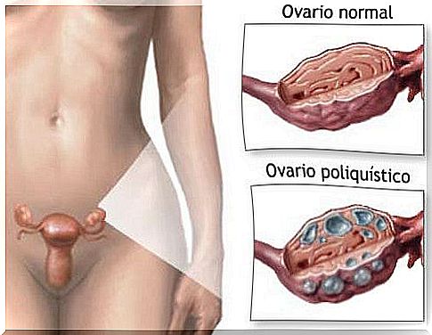 Natural treatment for polycystic ovary syndrome