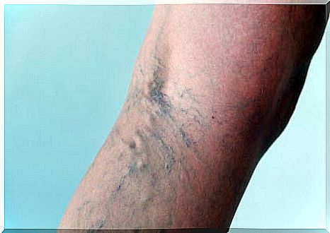 Varicose veins