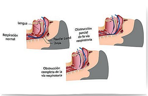 Snoring Physiology.