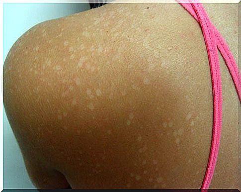 Pityriasis versicolor