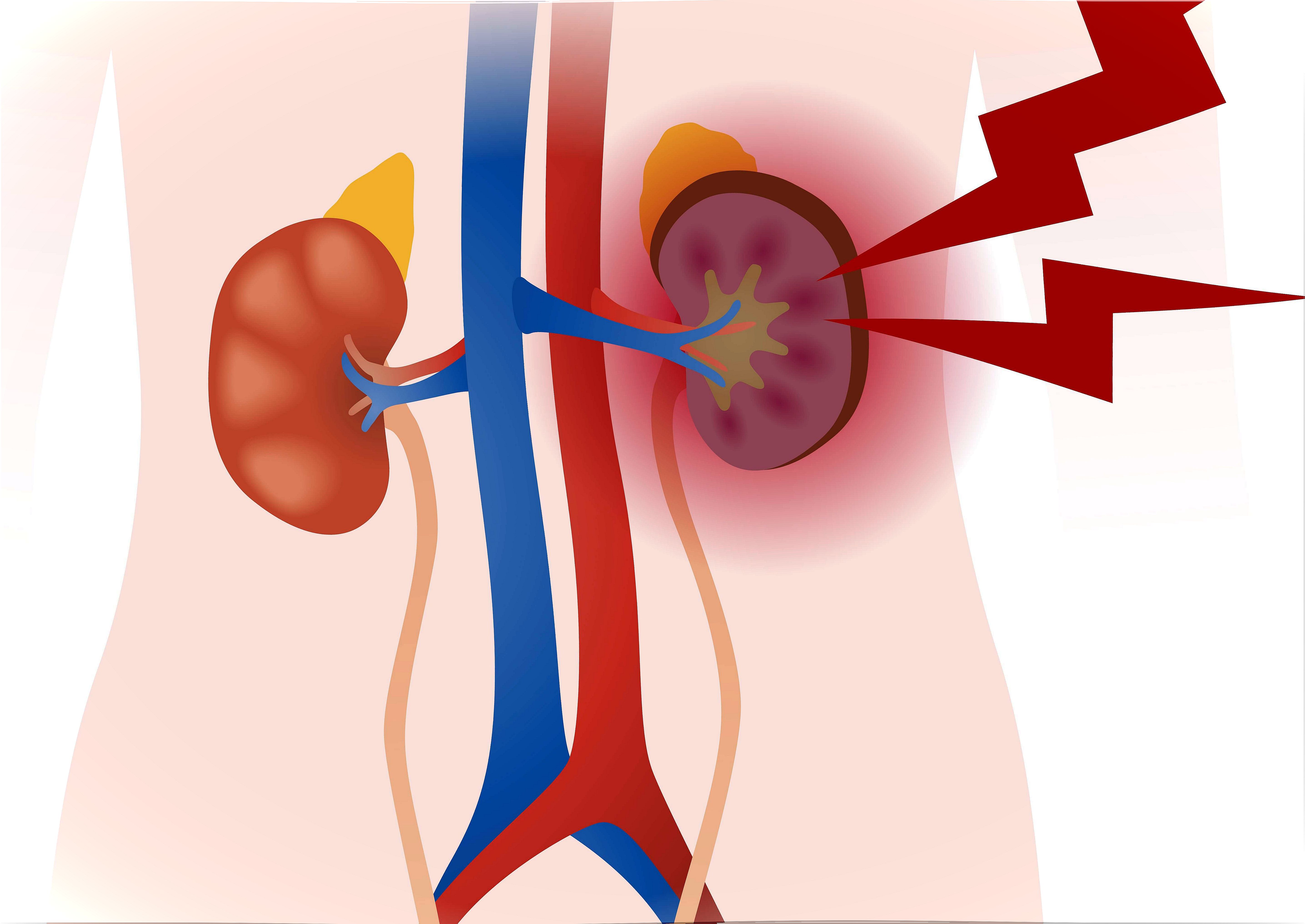 Vasculitis (inflammation of the blood vessels)