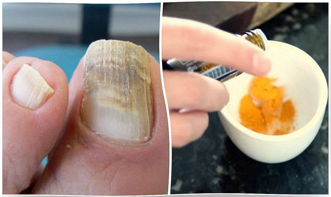 Turmeric natural treatment for nail fungus