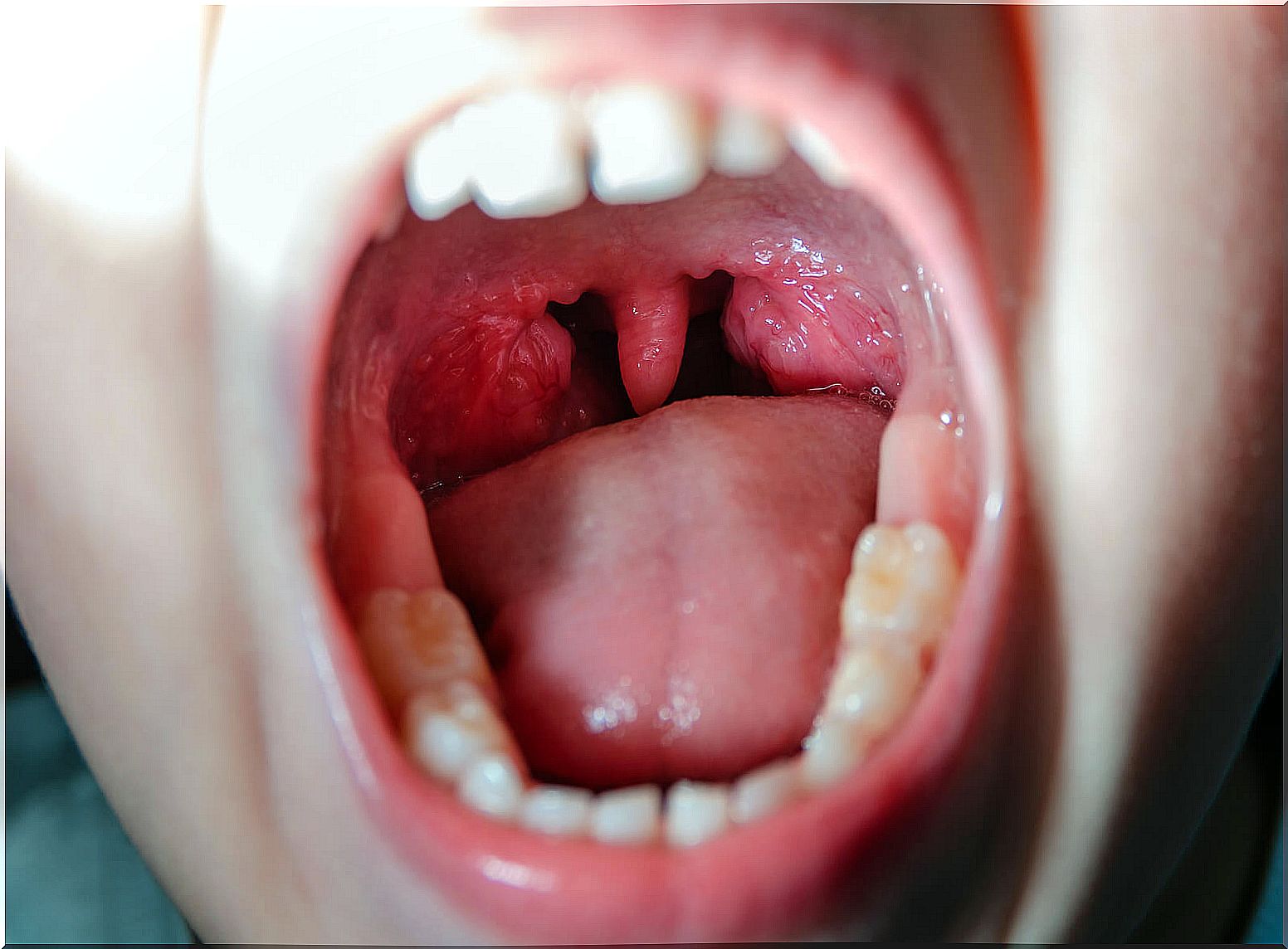 What is viral pharyngitis?